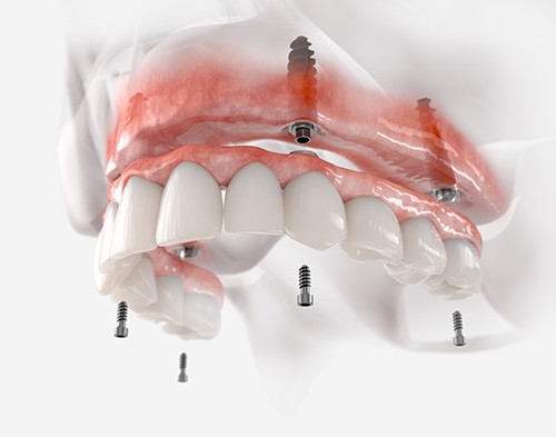 Artificial teeth by a keyboard holding a yellow paper that reads, “Dental Payment Plan”