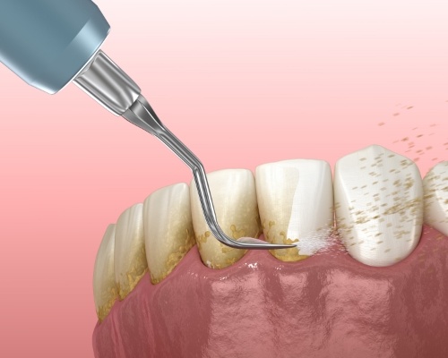 Animated dental tool removing plaque buildup from teeth during gum disease treatment in Jenks