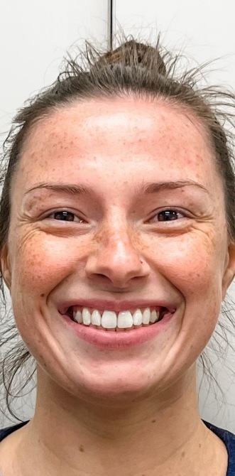 Woman smiling after getting her rotated tooth fixed by Jenks dentist